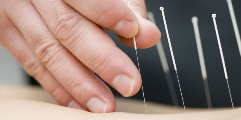 5 Benefits of Acupuncture You Wouldn’t Expect